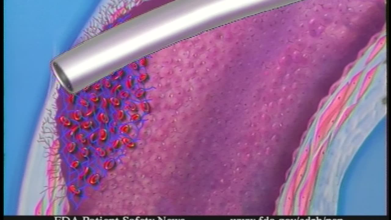 FDA Patient Safety News (Februa... - FDA Patient Safety News (February 2002) - gov.ntis.ava21054vnb1