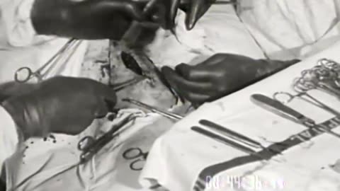 Autogenous Rib Cartilag... - Autogenous Rib Cartilage Implant into the Capsule of Tenon - fc-fc-1077