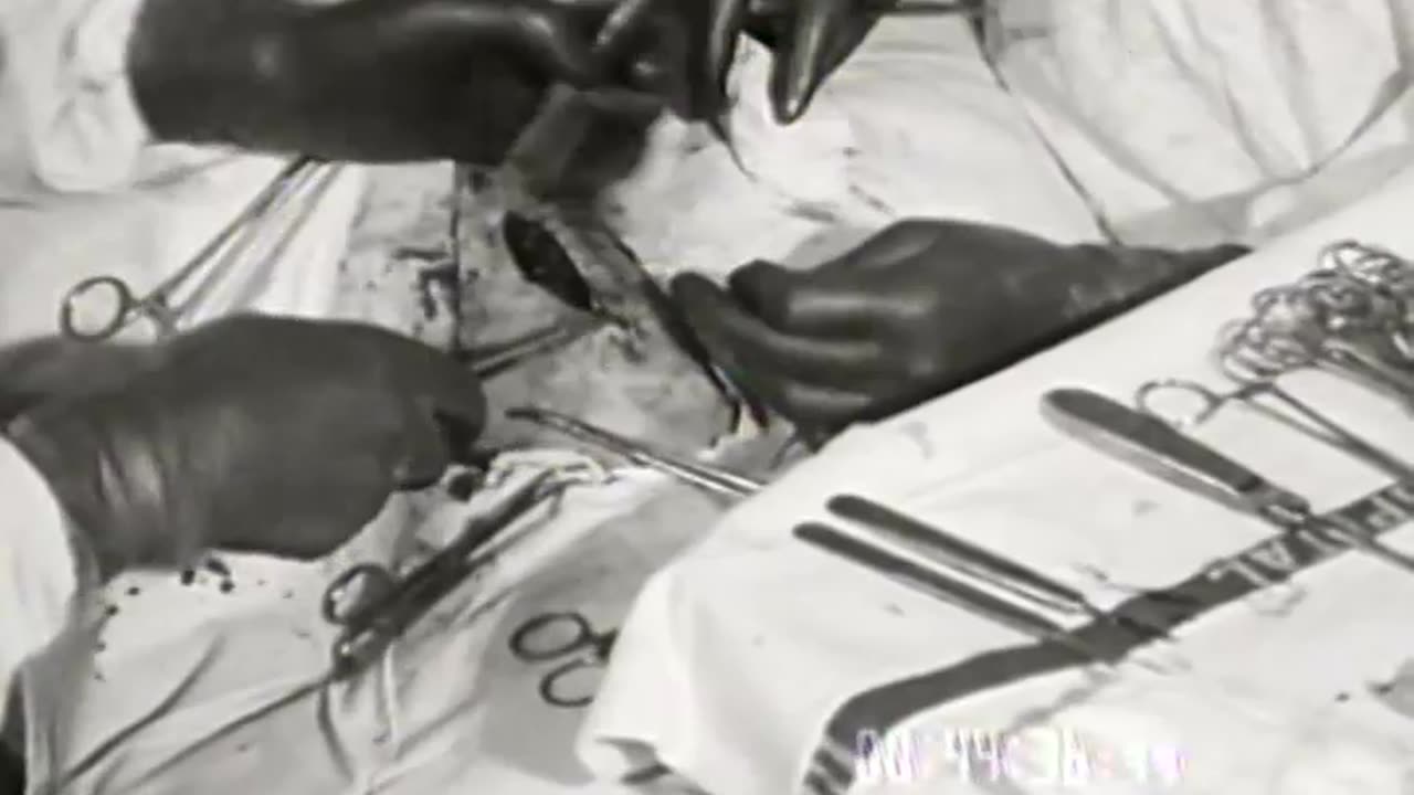 Autogenous Rib Cartilag... - Autogenous Rib Cartilage Implant into the Capsule of Tenon - fc-fc-1077