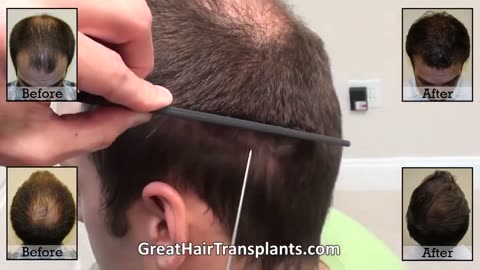 Dr. Brett Bolton: Hair Implant Scar Correction