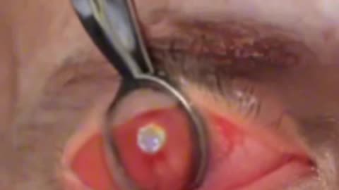 Eyelid Cyst Removal Surgery 3D Animation (Chalazion)