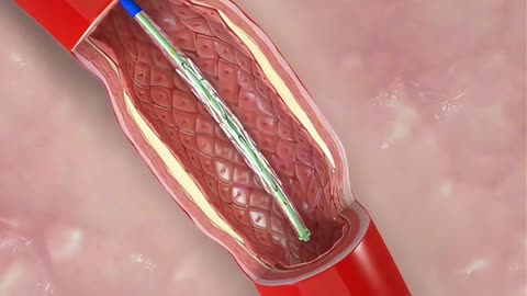 Angioplasty Procedure (3D Animation)