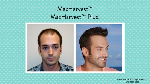 Great Hair Transplants – Dr. Brett Bolton MaxHarvest™ Procedure