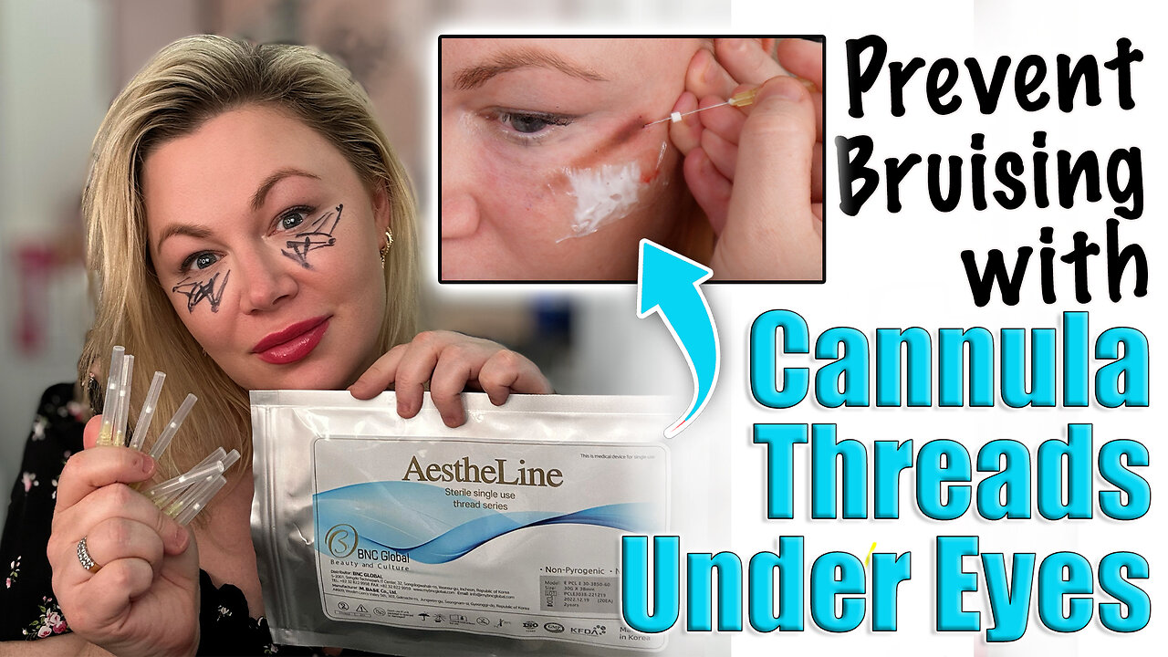 Prevent Bruising with Cannula PCL Under Eye Threads! ACeCosm.com and code Jessica10 Saves you money
