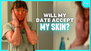 People Avoid Me Because Of My Skin - Will My Blind Date? | BORN DIFFERENT