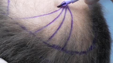 If you are concerned about hair loss or going bald, there is no need to worry.