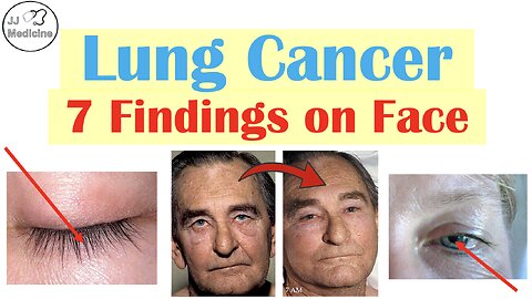 7 Changes on the Face That May Point to Lung Cancer