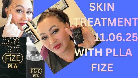 PLLA "FIZE" TEMPLE AND CHEEK TREATMENT. DISCOUNT CODE NAT10 11.06.25