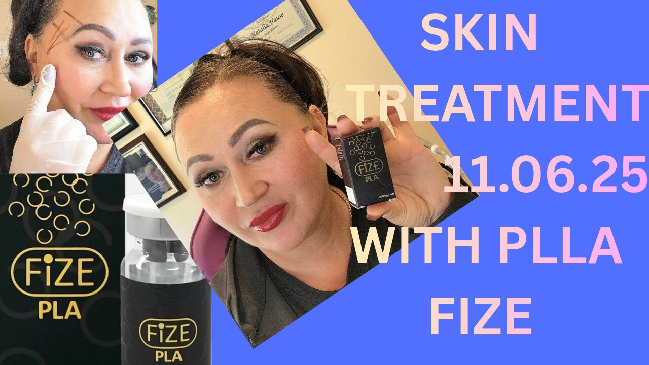 PLLA "FIZE" TEMPLE AND CHEEK TREATMENT. DISCOUNT CODE NAT10 11.06.25
