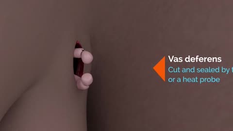 Vasectomy Procedure 3D Animation