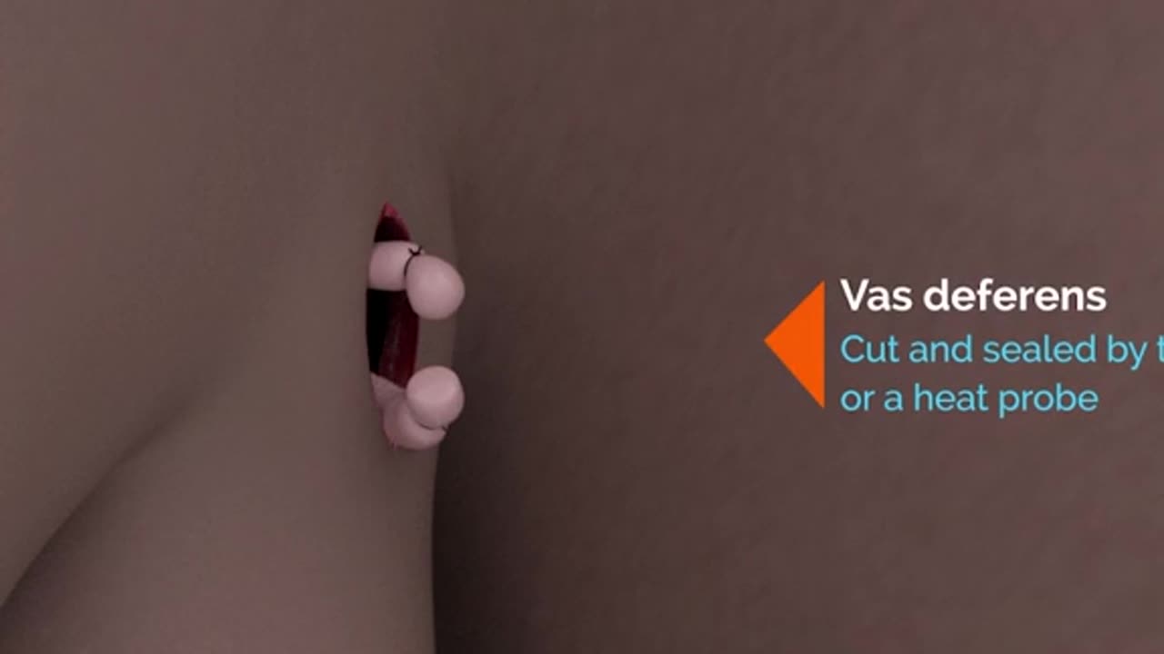 Vasectomy Procedure 3D Animation