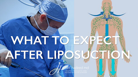 What to Expect After Liposuction | Post-Op Care and Recovery