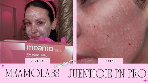 Mesotherapy Meamo Labs Juenitique PN Pro & Hyaron Target Nasolabial Folds Code: JAMIE