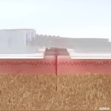 This device stitches you up
