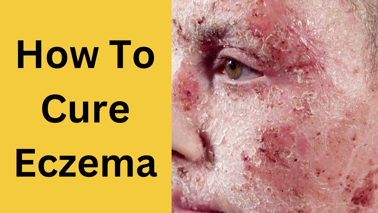 How to get rid of Eczema