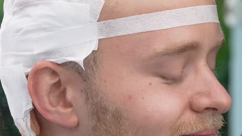 We take great care in achieving natural results in hair transplants.