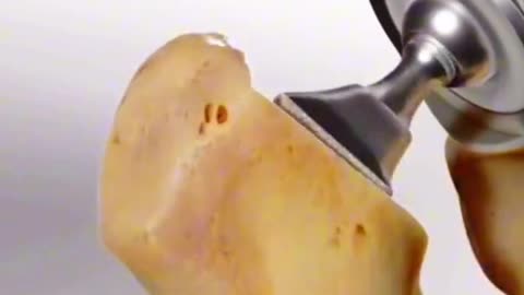 How Hip Replacement Surgery Is Performed (3D Animation)