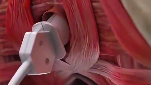 V-Tone Procedure – Restore & Strengthen Intimate Wellness.