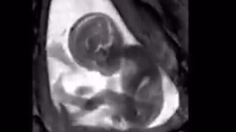 ✝️🔬🤱🙌🙏 GUESS HOW OLD INFANT TEASPOON SIZED DEVELOPED BABY EMBRYO ULTRASOUND🧒