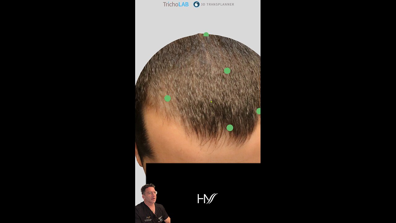 New Surgery Day! (33M, frontal thinning)