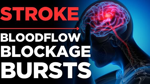 Stroke: How to Prevent Your First (or Next) Stroke | Medickpidia