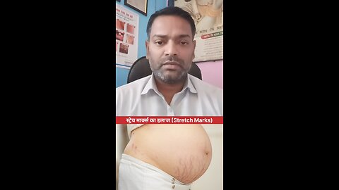 स्ट्रेच मार्क्स का इलाज (Stretch Marks)