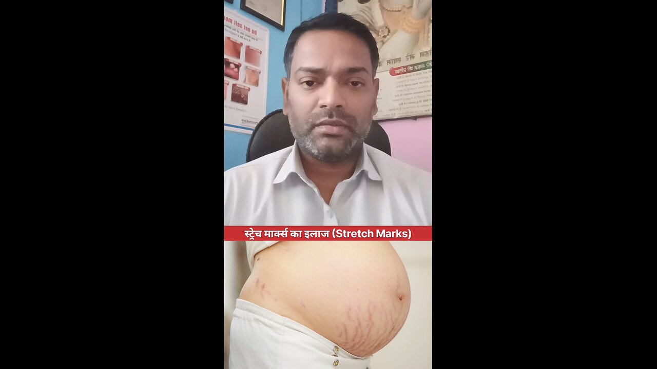 स्ट्रेच मार्क्स का इलाज (Stretch Marks)