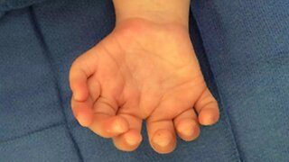 Jimmy Carr Teaches Us That Webbed Fingers Is Not So Good