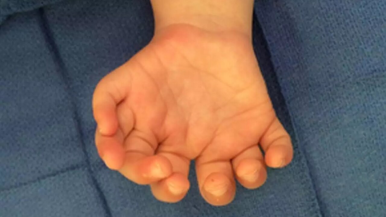 Jimmy Carr Teaches Us That Webbed Fingers Is Not So Good