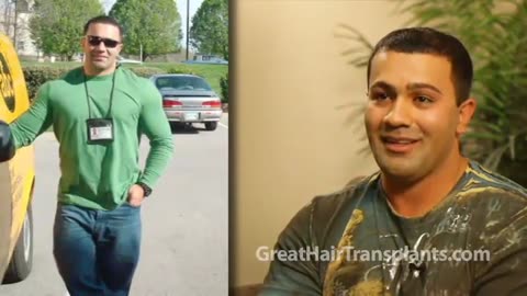 Dr. Brett Bolton Restores Burn Patient’s Hair with Hair Transplant