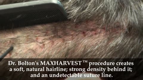 Undetectable Hair Implant Scar – Dr. Brett Bolton