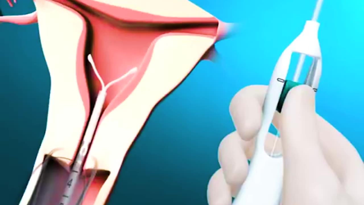 How Intrauterine Device (IUD) Is Inserted