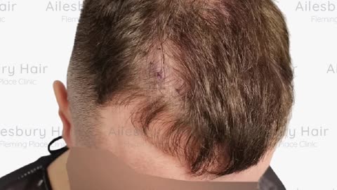 Best Hair Loss Treatment for Men | Ailesbury Hair Fleming Place Clinic