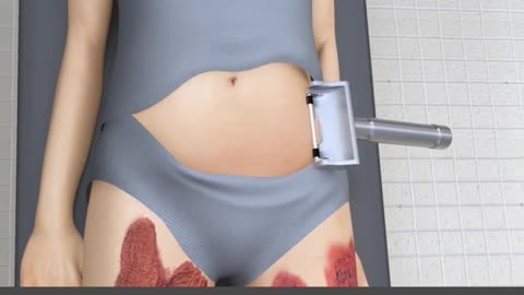 Skin Graft Procedure 3D Animation