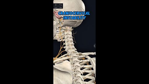 Craniocervical instability and chronic health issues | Neckwise Upper Cervical Chiropractic