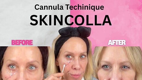 SkinColla Recombinant Collagen — Cannula with Under-Eye Updates