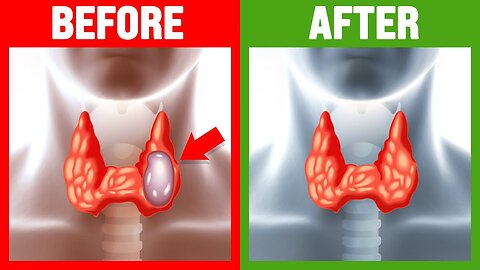 How To Cure Hypothyroidism ( Underactive Thyroid )