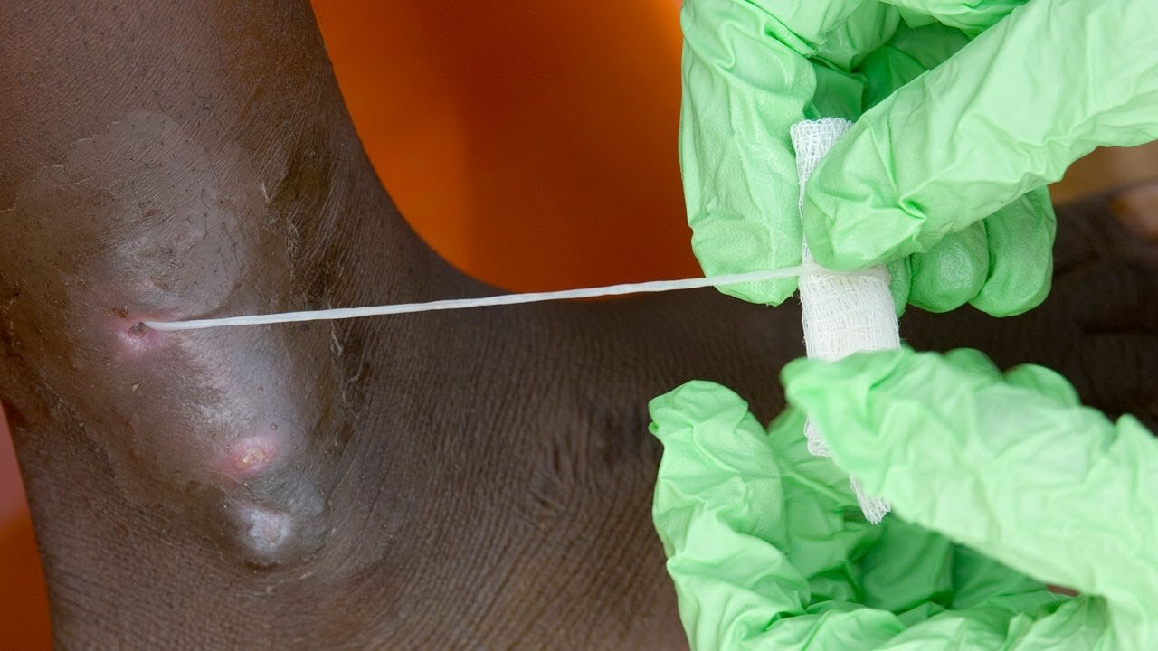 Guinea Worm Disease Eradication