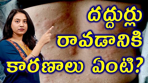 దద్దుర్లు రావడానికి కారణాలు ఏంటి? Cause and Risk factors for Urticaria Hives or Wheals | హోమియోపతి