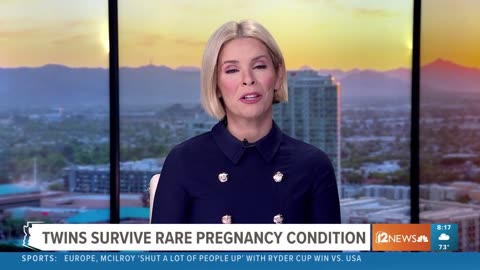 East Valley twins survive rare condition, in-utero surgery