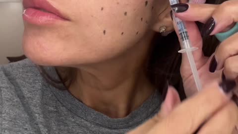 Miracle L Liquid Facelift Treatment