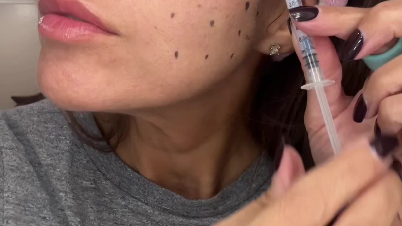 Miracle L Liquid Facelift Treatment