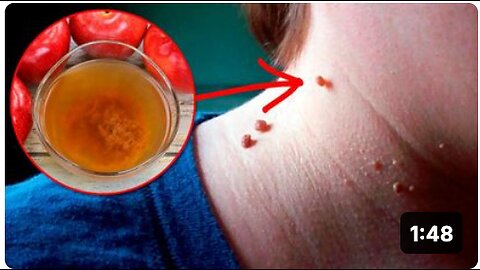 How to Remove Skin Tags Naturally at Home