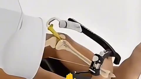 Femur Nail Surgery – Procedure & Recovery Explained