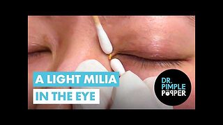 MILIUM Eye Candy Dr Pimple Popper Satisfies Patient s Request
