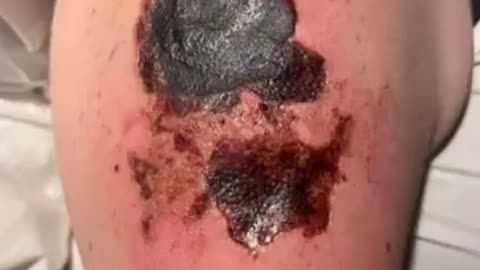 This patient's booster injection site is necrotic...