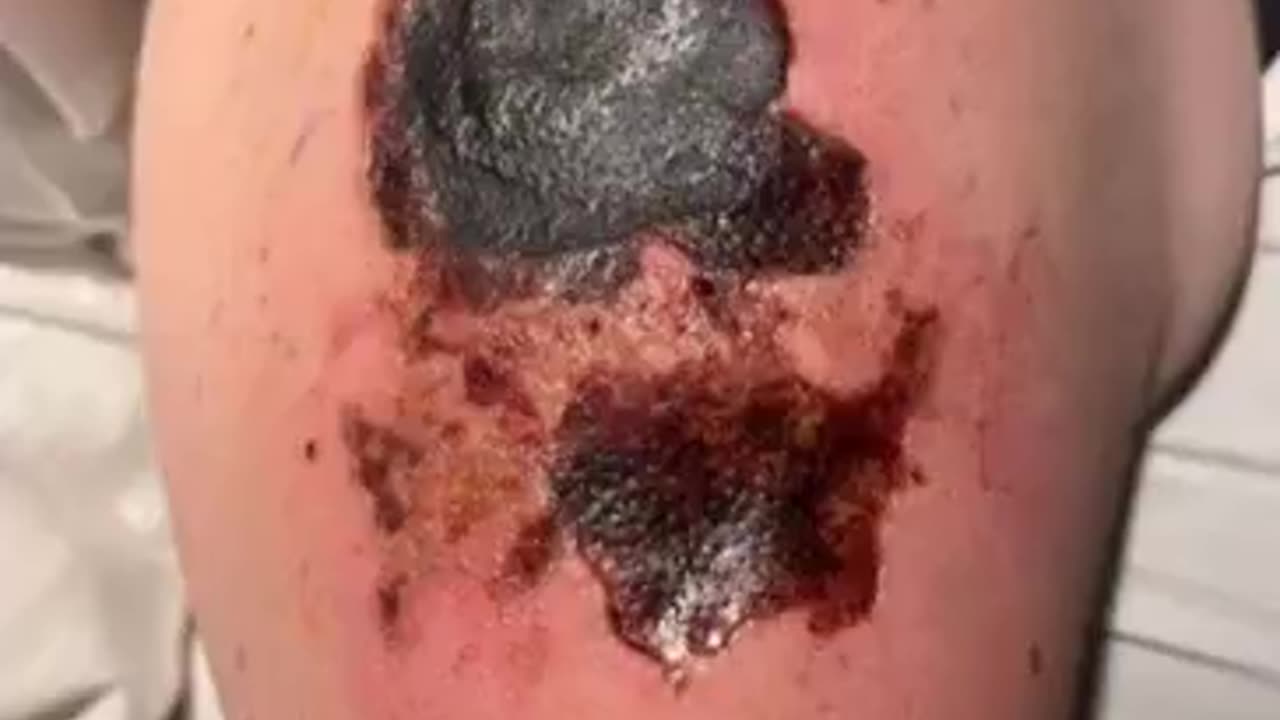 This patient's booster injection site is necrotic...