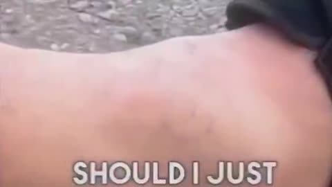This dude wrecked his ankle skateboarding and debated going to the ER.