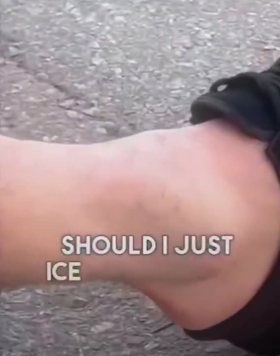 This dude wrecked his ankle skateboarding and debated going to the ER.