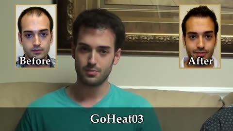 Dr. Brett Bolton’s Unmatched Results Stir Controversy on the Hair Transplant Network